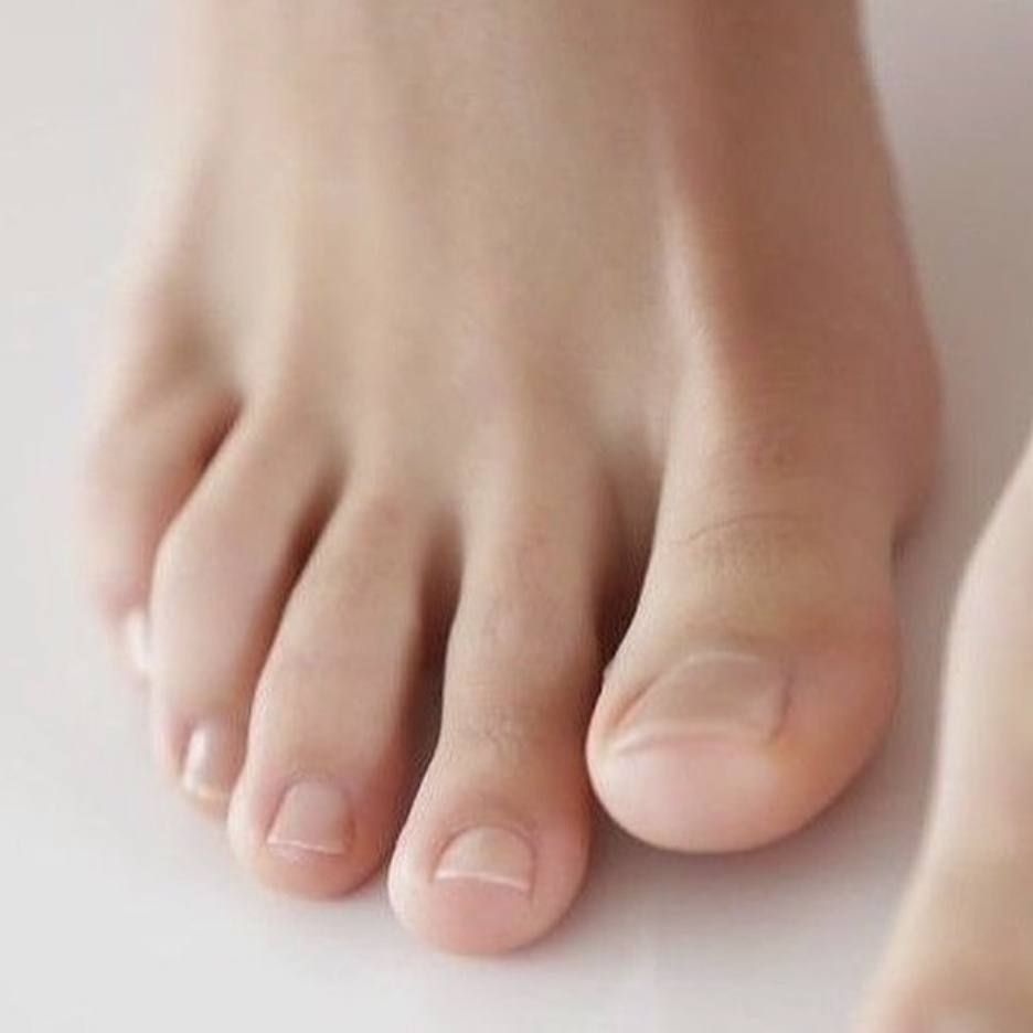 Подология. Удаление вросшего участка пластины 1 ноготь