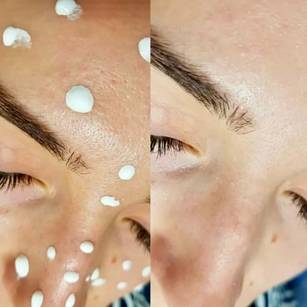 Фонофорез (фарфоровая куколка)