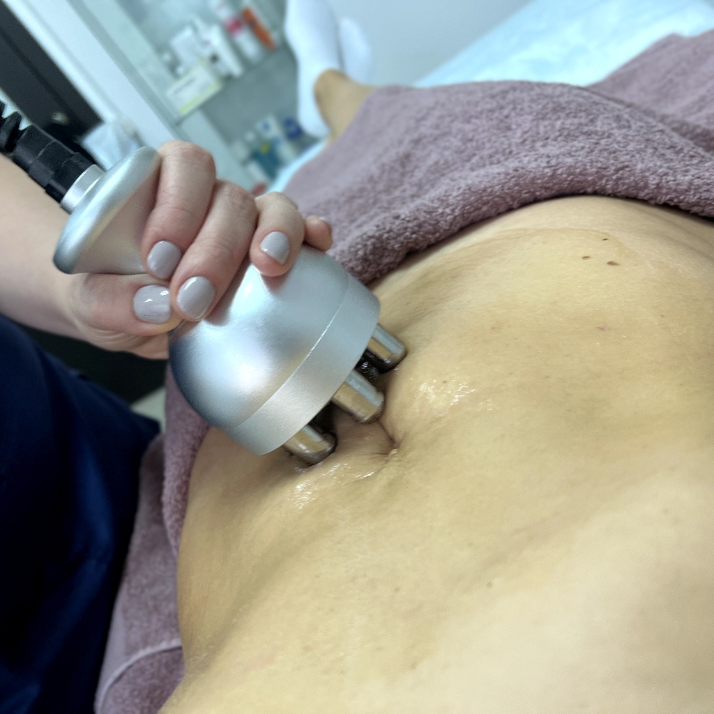 RF лифтинг тела