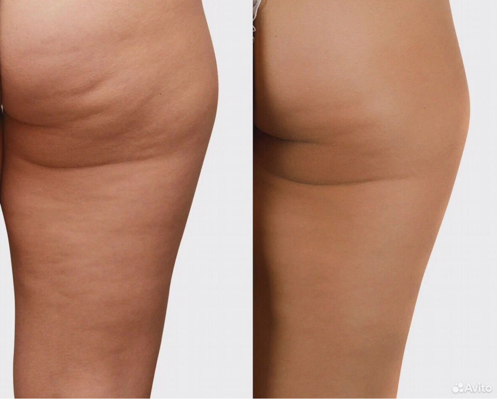 Антицеллюлитный массаж (бедра, ягодицы)