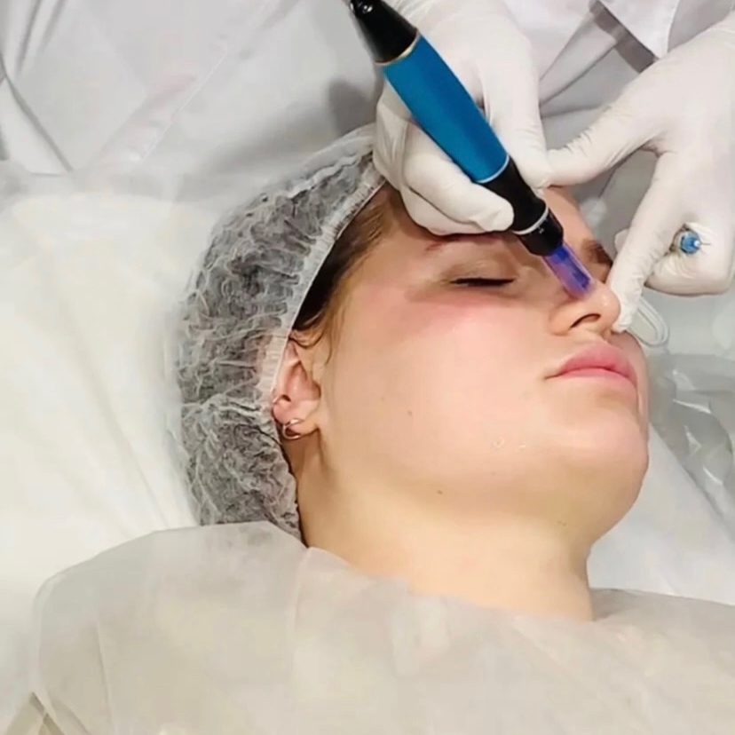 Фракционная мезотерапия