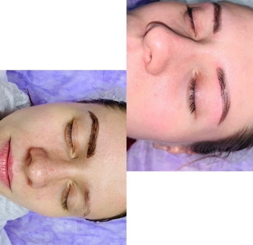 Чистка лица(комбинированная, вакуумная, ультразвук)