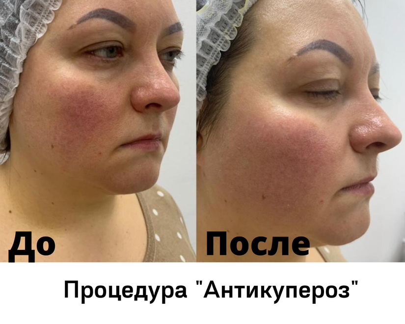 Программа «Антикупероз»