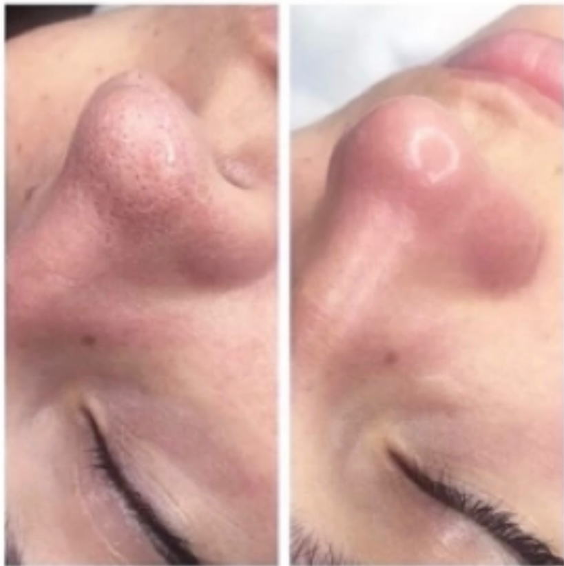 Чистка +пилинг