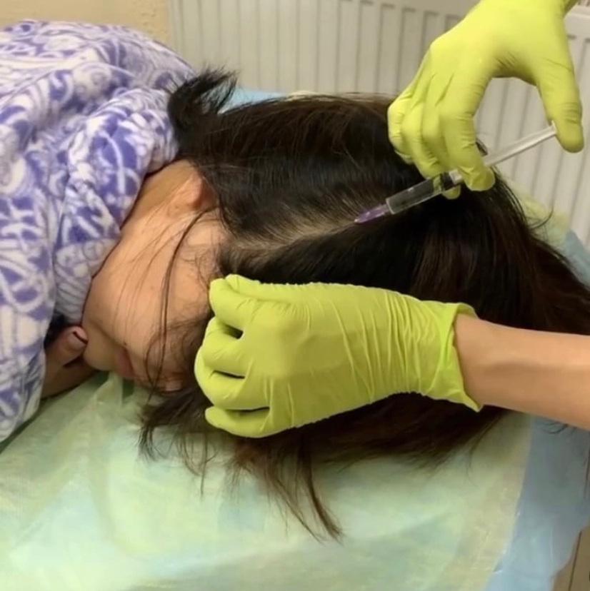 Мезотерапия головы