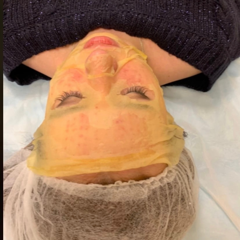 Мезотерапия лица