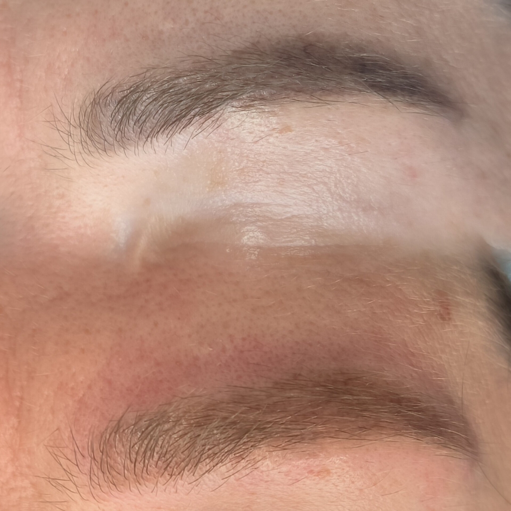 Лазерное удаление перманентного макияжа бровей