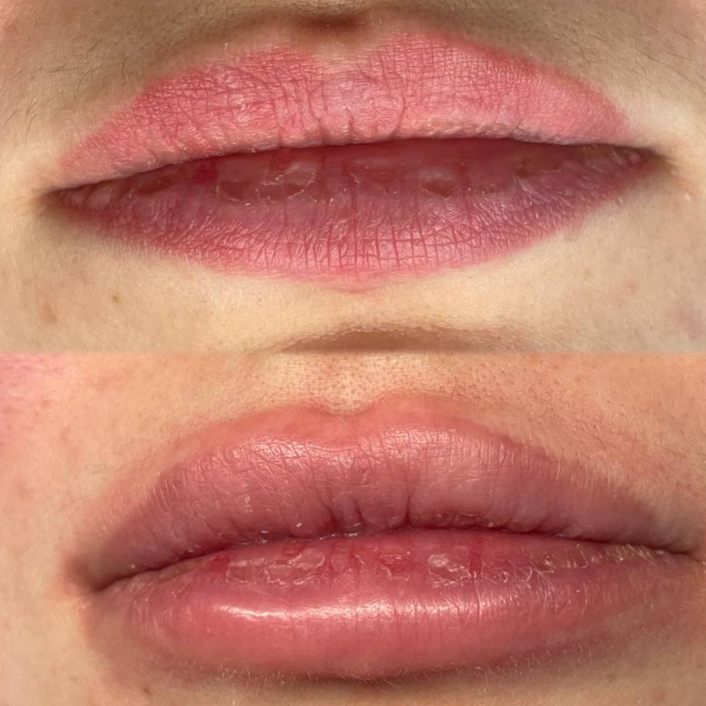 Лазерное удаление перманентного макияжа губ