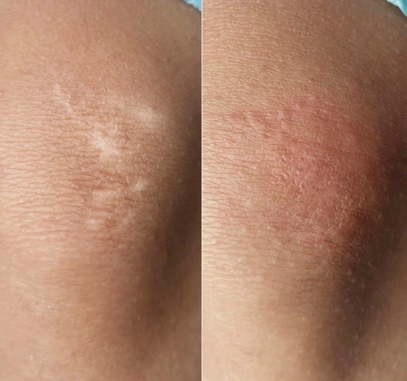 Перманентный макияж Камуфляж рубцов и шрамов