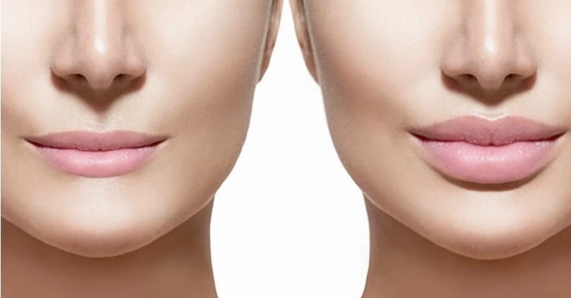 Контурная пластика губ