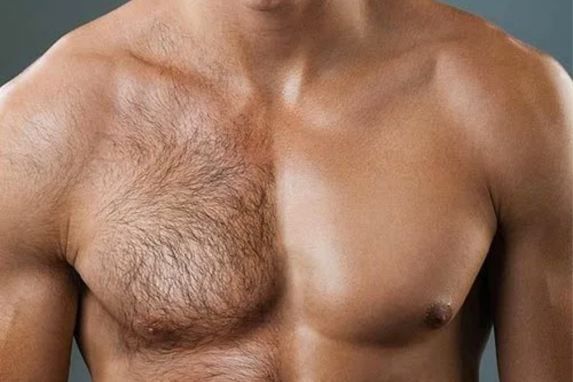 Депиляция Груди