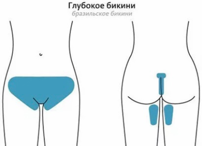 Депиляция  Бикини  глубокое +ягодицы + часть ног