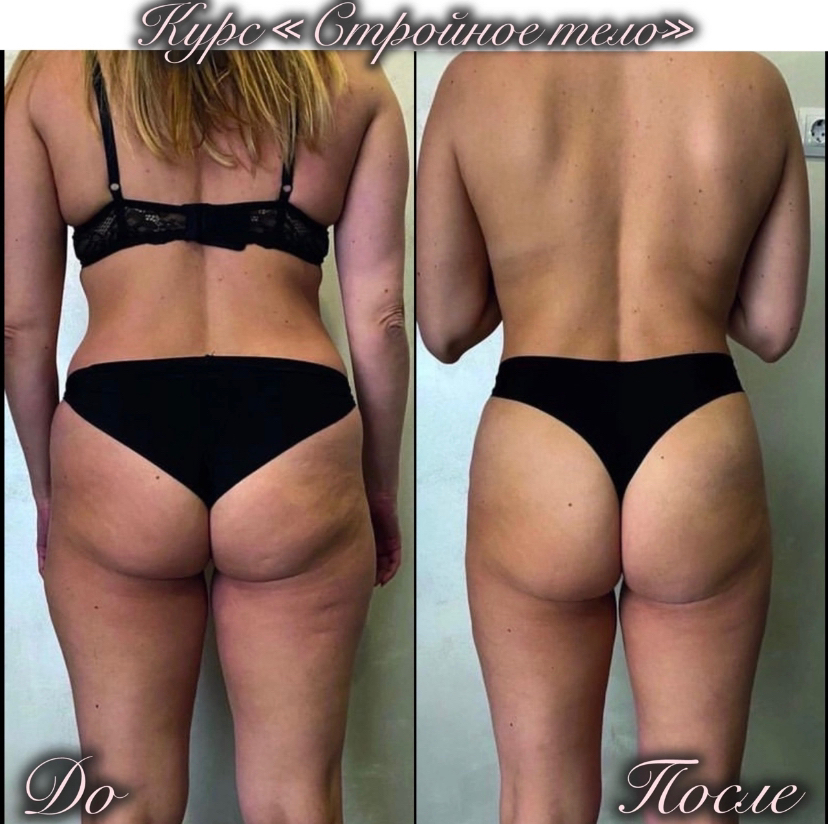 Липолитик по телу