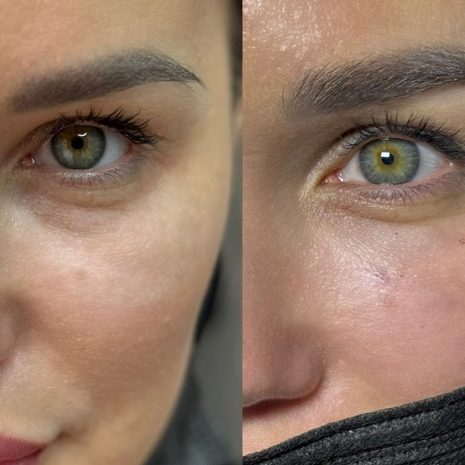 Мезотерапия век