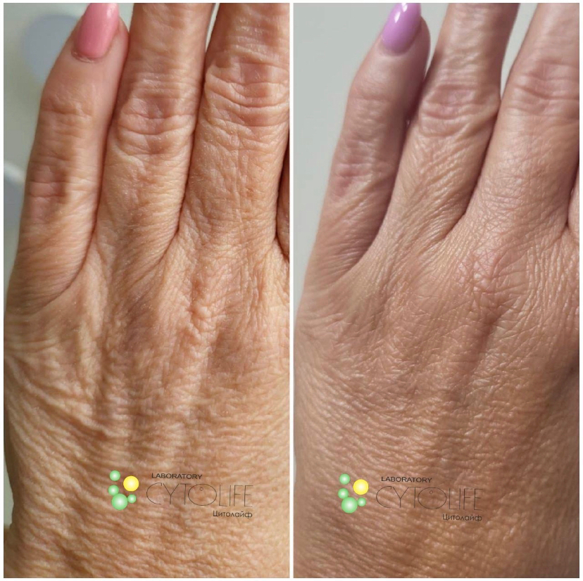 Мезотерапия кистей рук