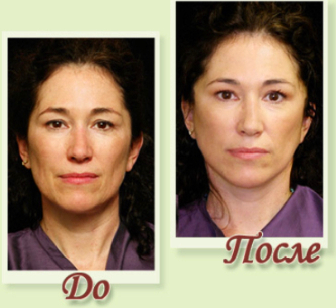 Биоармирование (мезонити)