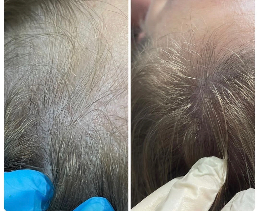 Мезотерапия головы