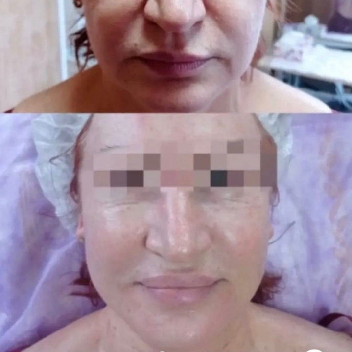 Удаление носогубных морщин