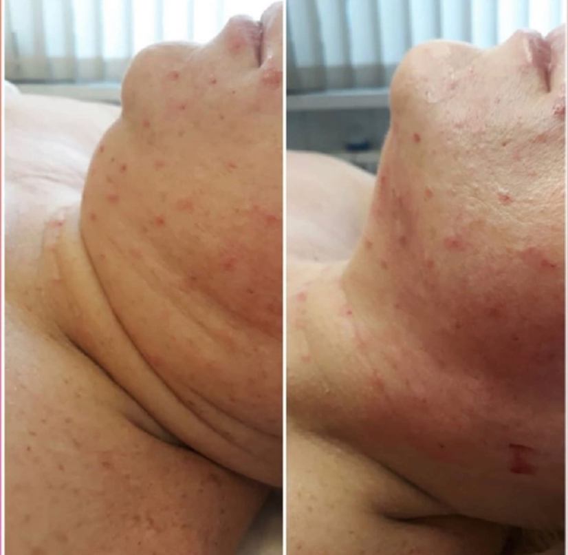 Липолитик по лицу