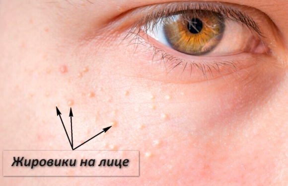 Удаление жировиков (милиумов)