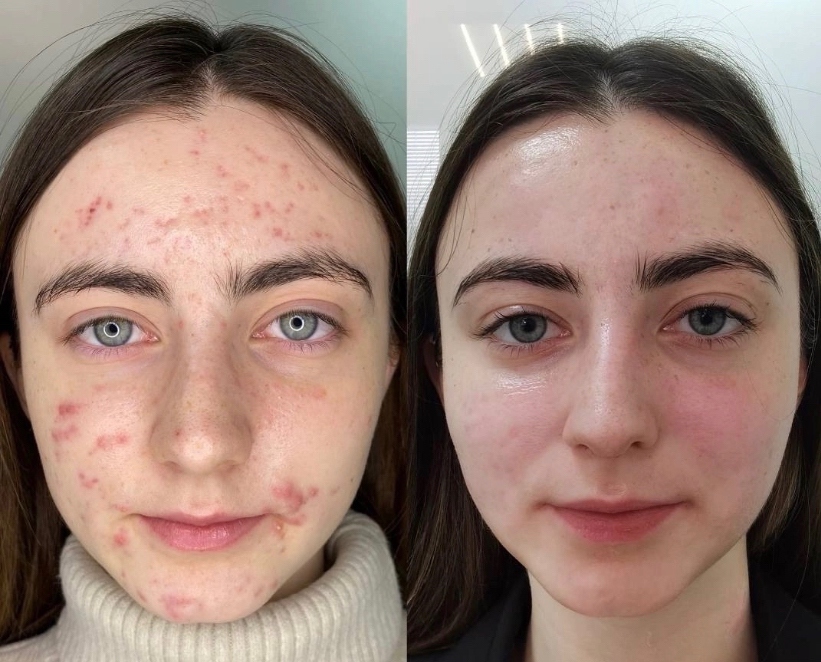 Микродермабразия