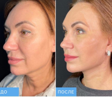 WOW - ЛИФТИНГ