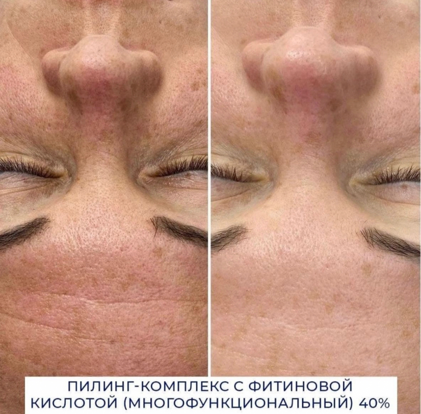 Пилинг всесезонный