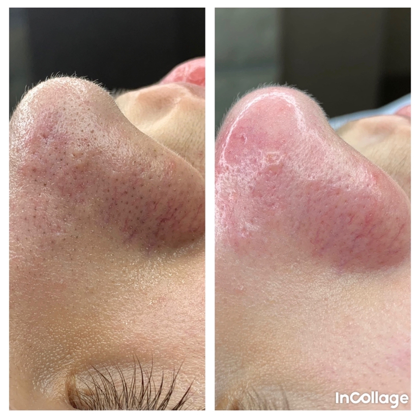 Чистка лица