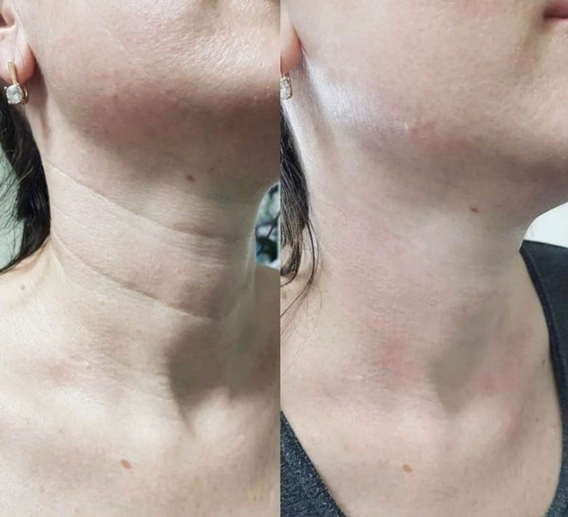 Мезотерапия ( до 30 лет)