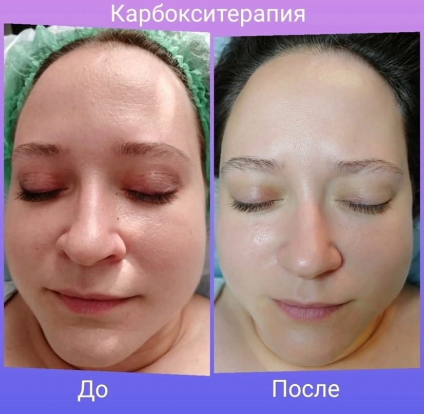 Карбокситерапия неинвазивная