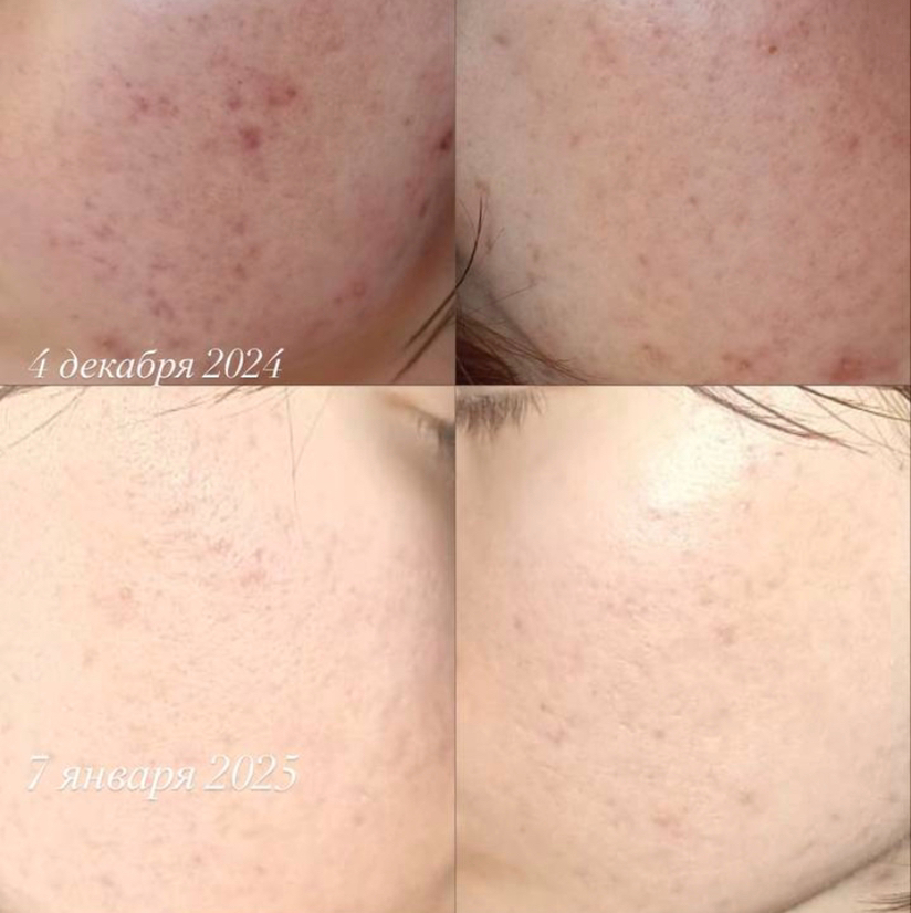 Лечение акне (воспалений) и рубцов