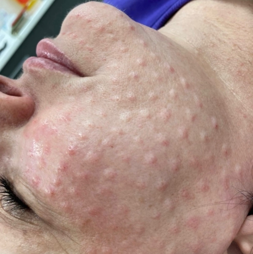 Биоревитализация лица+шеи