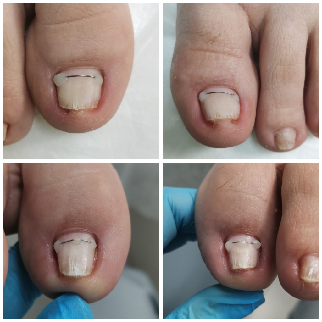 Установка титановой нити ,ед