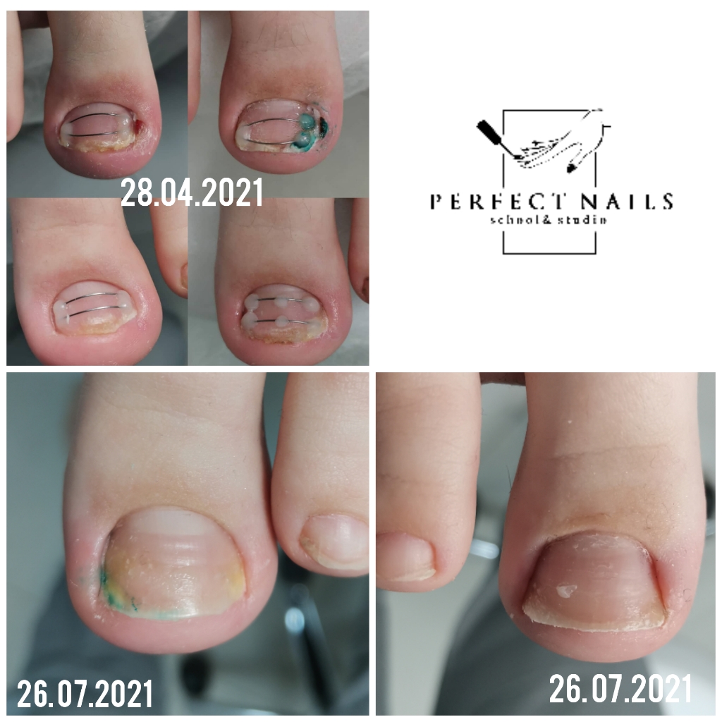 Коррекция титановой нити,ед