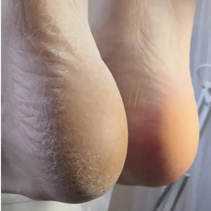 Обработка стоп гигиеническая