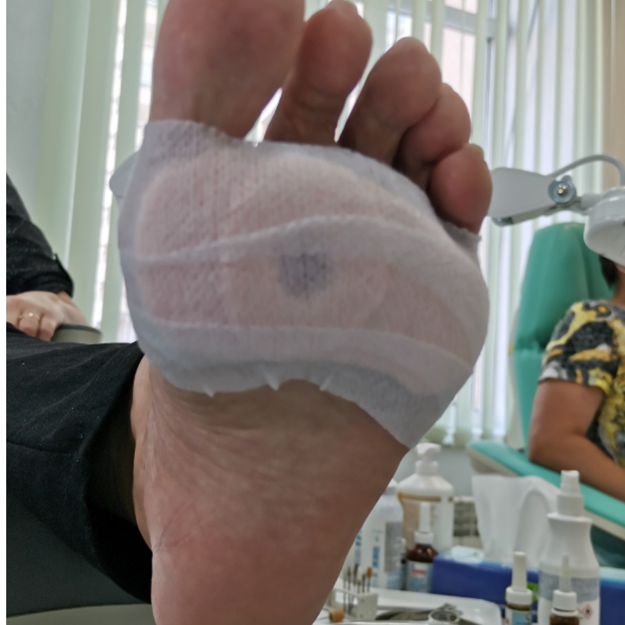 Установка разгрузки при гиперкератозах