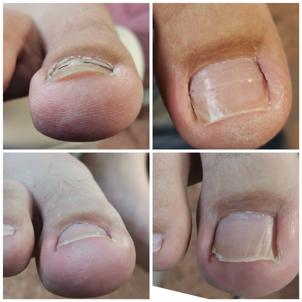 Изготовление и установка скобы Фрезера