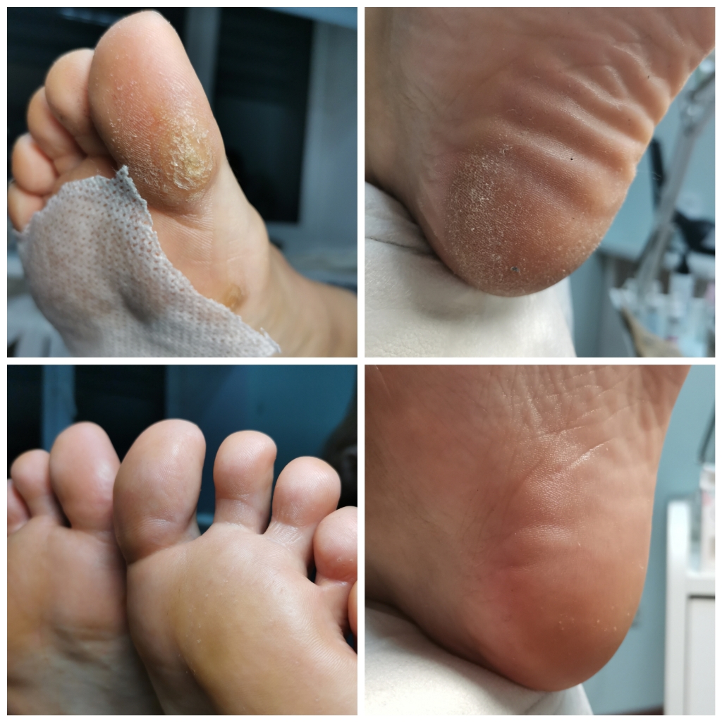 Обработка гиперкератозов