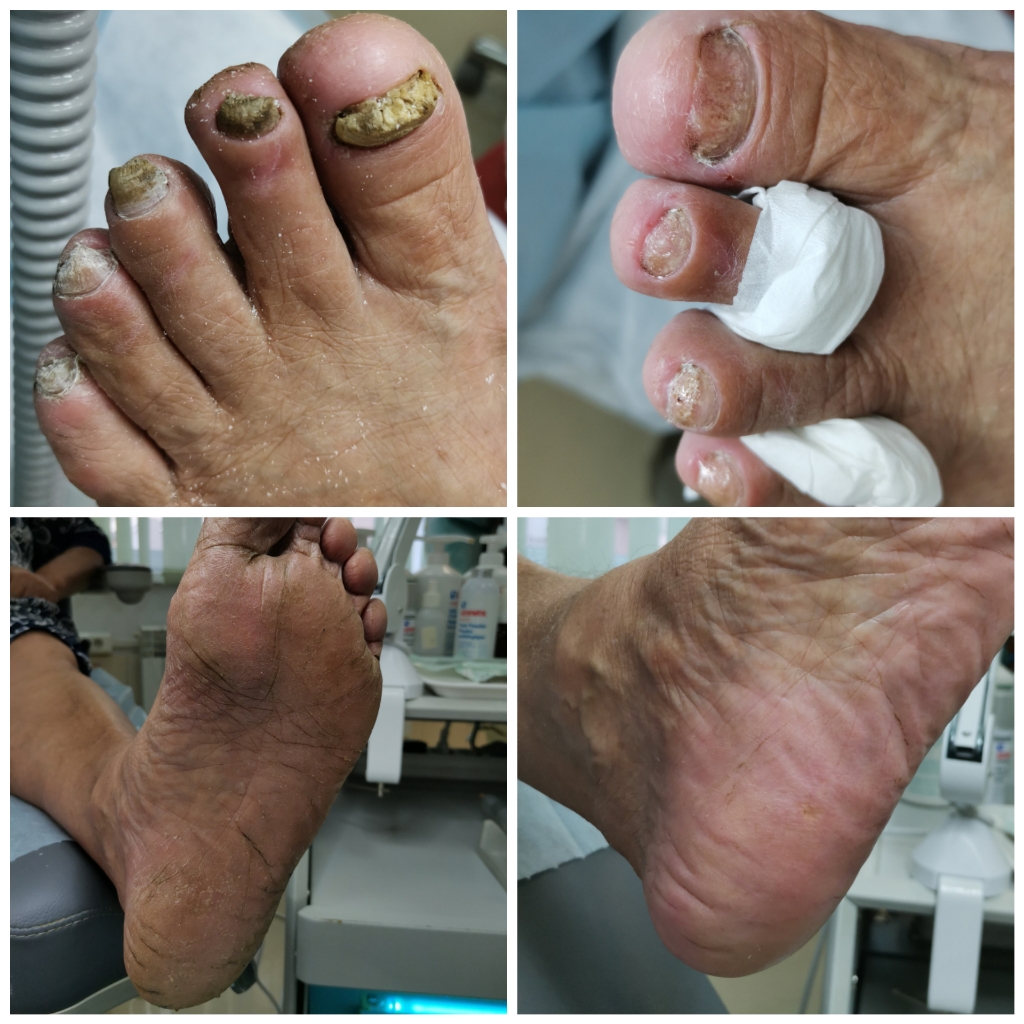 Парамедицинский педикюр