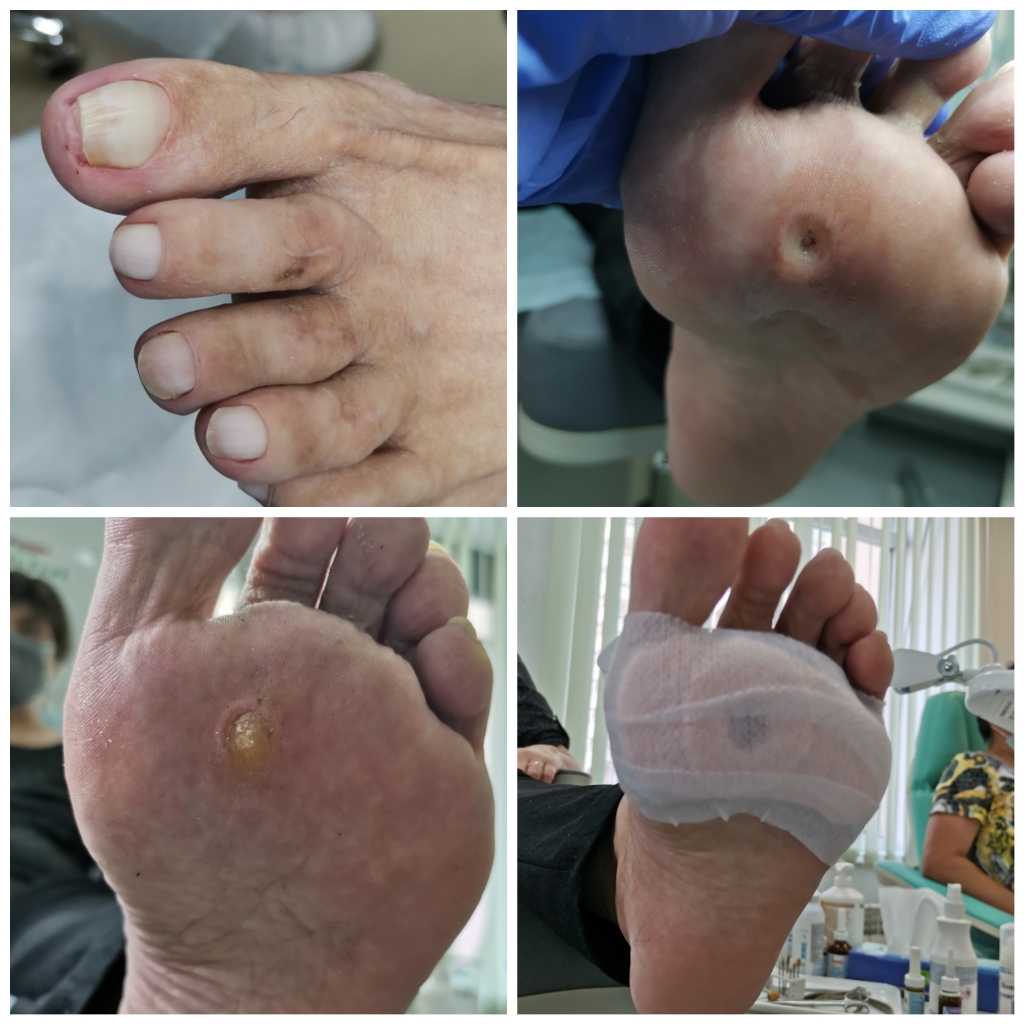 Удаление стержневой мозоли