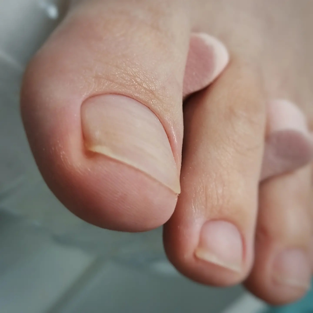 Обработка Пальцев Ног