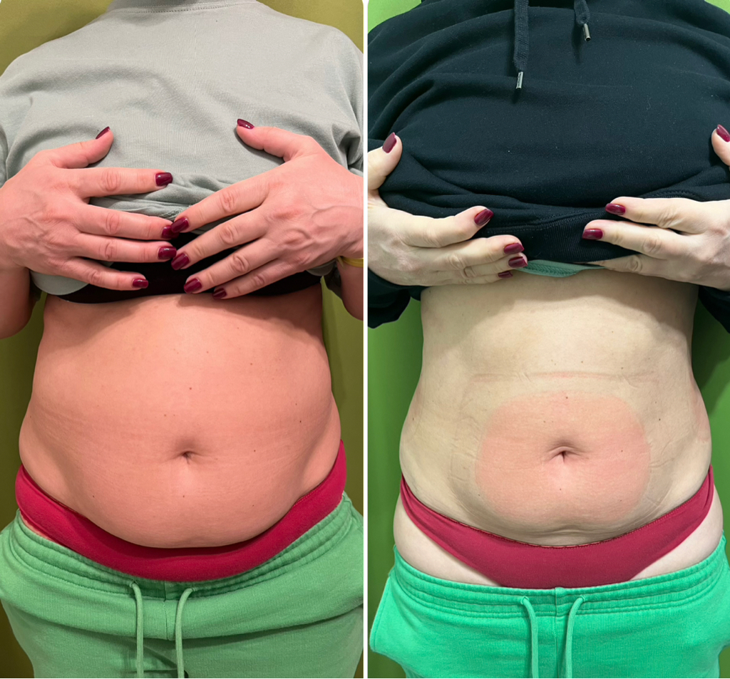 Криолиполиз все тело (8 насадок) 1,5 часа