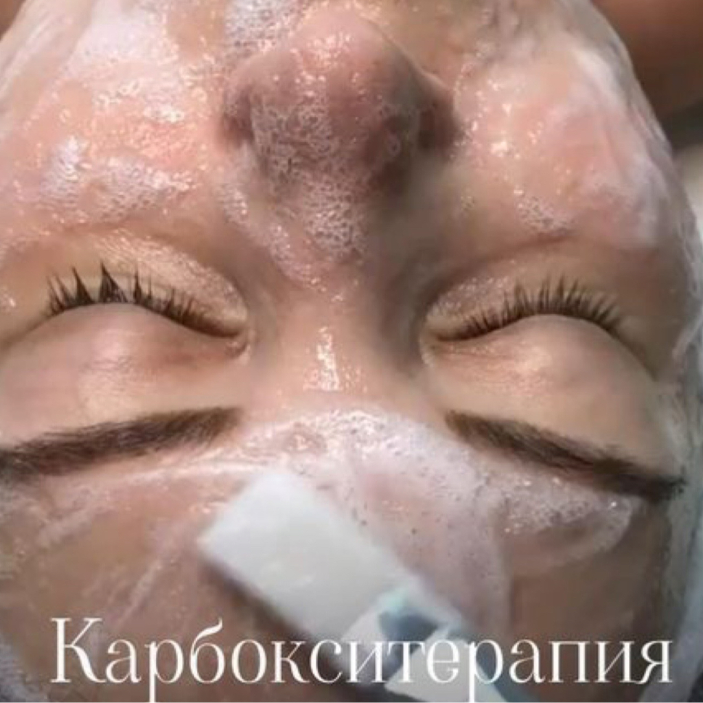 Карбокитерапия