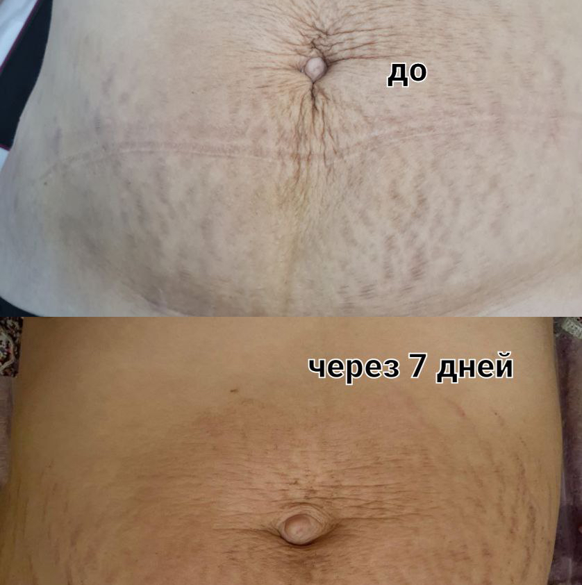 Холодная Плазма (живот)