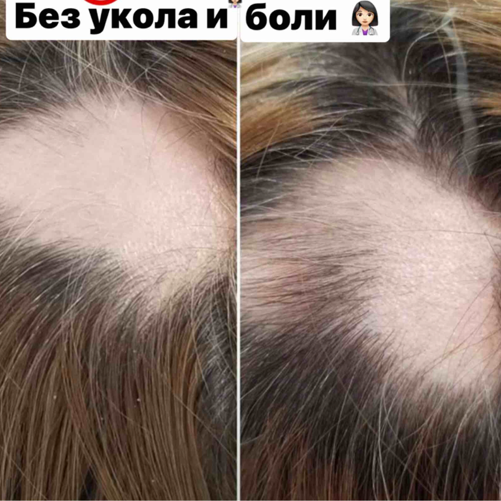 Холодная Плазма (от выпадения волос) 👱🏼‍♀️
