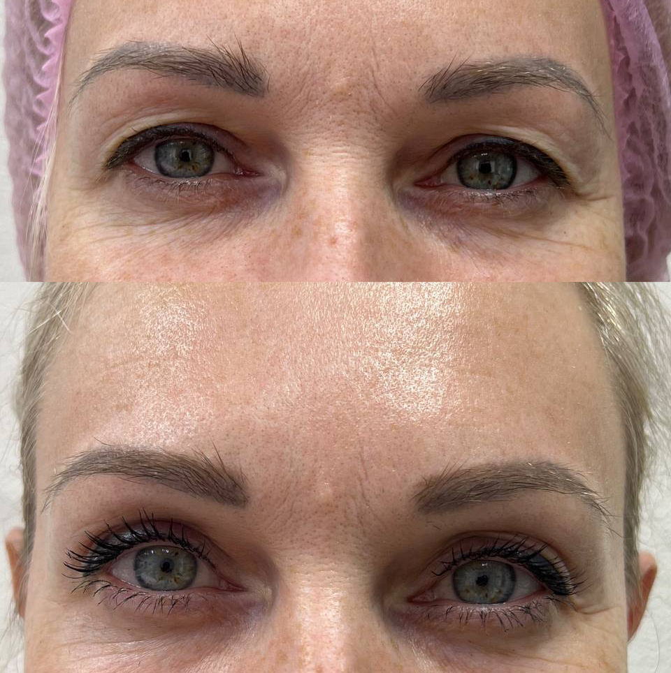 Блефоропластика