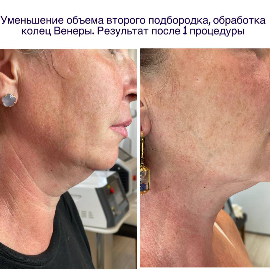 Холодная Плазма (шея+ кольца Венеры)🤩