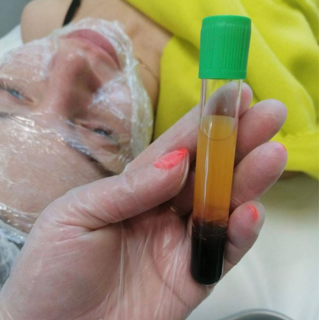 Плазматерапия