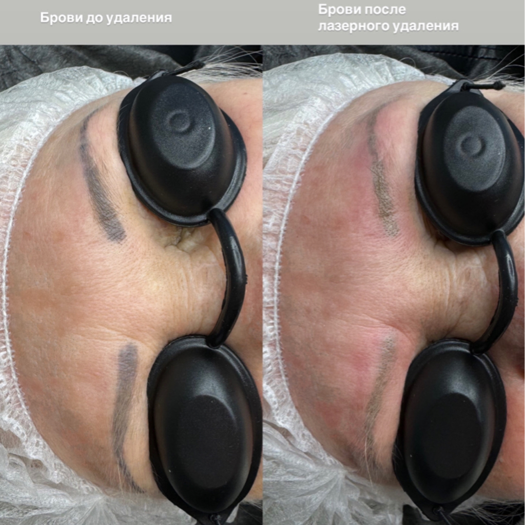 Удаление бровей ремувером/лазером