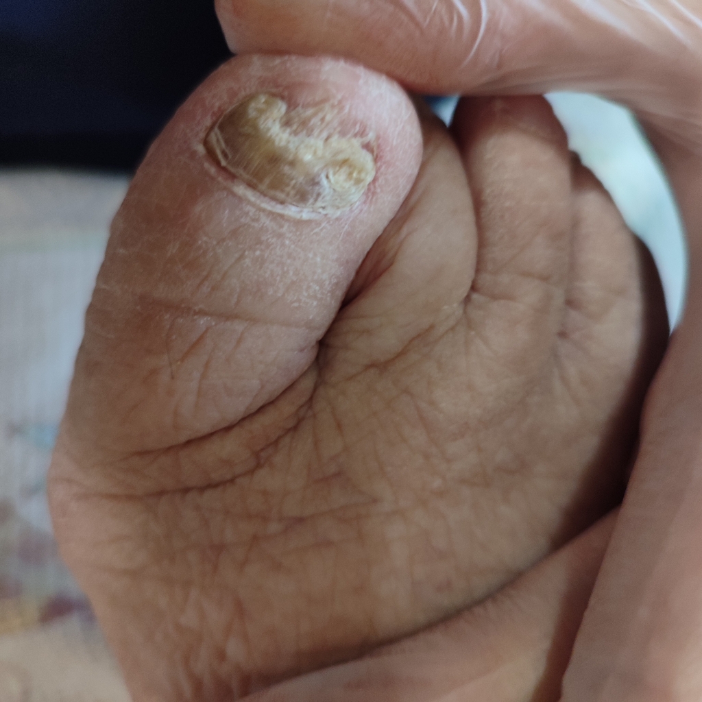 Обработка утолщенных ногтей и пальцев для пожилых и маломобильных людей